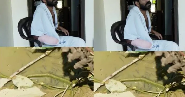 കുളം വൃത്തിയാക്കു​മ്പോൾ ഒരു മുള്ള് കുത്തിയപോലെ വേദന; പരിശോധനയിൽ മുഷി വിഭാഗത്തിൽപ്പെട്ട അപകടകാരിയായ മീൻകൊത്തിയെന്ന് കണ്ടെത്തി; അപൂർവയിനം അണുബാധ ശരീരത്തിലേക്ക്; യുവാവിന്‍റെ വലത് കൈപ്പത്തി മുറിച്ചുമാറ്റി