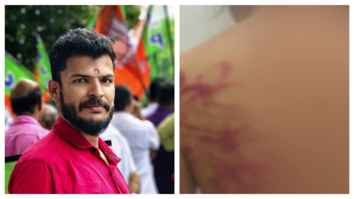 മൊബൈൽ ചാർജർ കേബിള് ഉപയോഗിച്ച് ക്രൂരമർദനം: പങ്കാളിയെ മർദിച്ചെന്ന പരാതിയിൽ യുവമോർച്ച നേതാവ് കസ്റ്റഡിയിൽ മൊബൈൽ ചാർജർ കേബിള് ഉപയോഗിച്ച് ക്രൂരമർദനം: പങ്കാളിയെ മർദിച്ചെന്ന പരാതിയിൽ യുവമോർച്ച നേതാവ് കസ്റ്റഡിയിൽ