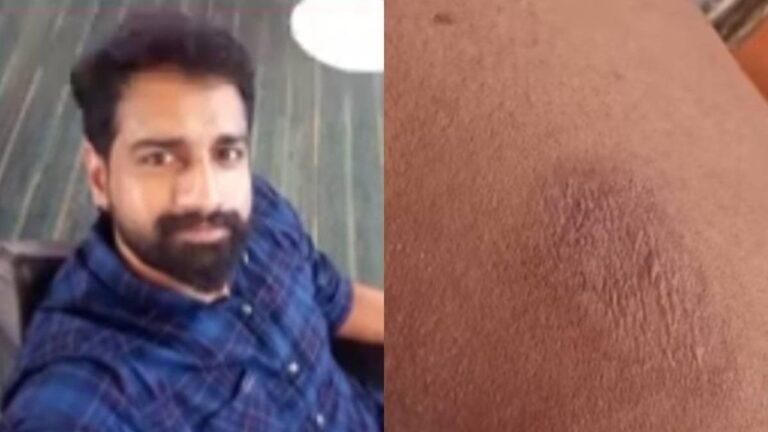 കിണർപണിക്കിടെ സൂര്യാഘാതം; കണ്ണൂരിൽ യുവാവ് മരിച്ചു, കോഴിക്കോട്ട് അങ്കണവാടി ജീവനക്കാരിക്ക് പൊള്ളൽ