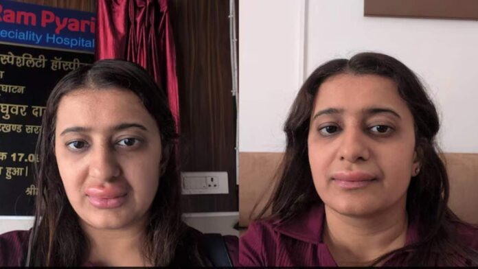 വന്ദേഭാരതിൽനിന്ന് ഭക്ഷണം കഴിച്ചു,അലർജിയെ തുടർന്ന് ചുണ്ടുകൾ വീർത്തു; കുറിപ്പുമായി യുവതി